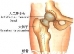人工股骨头置换术后护理