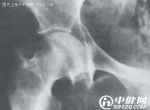 多发性骨髓瘤的手术治疗和化疗指导