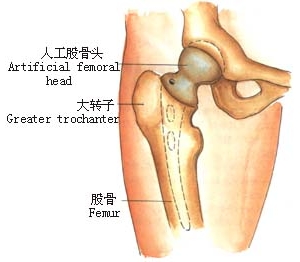 人工股骨头置换术后护理