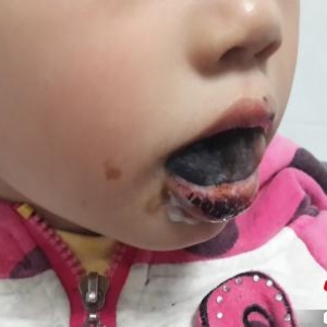 女童误将高锰酸钾片当糖果误食医生紧急处理