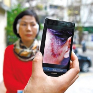 花四万多元整容换青春 换来脸部化脓两个月