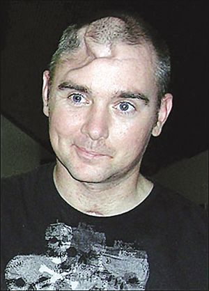 英士兵被子弹射穿太阳穴 1个月后奇迹生还