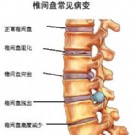 我们应知道腰椎间盘突出症