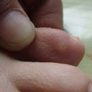 激光治疗鸡眼的优点及缺点